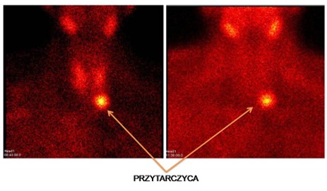 przytarczyca